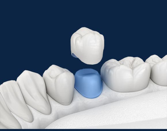 Dental Crowns