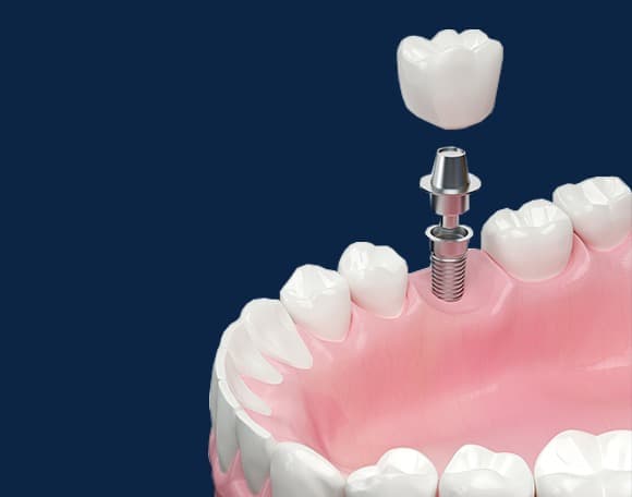 Dental Implants